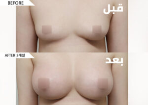 ar_breast01_bnf02_03