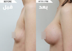 ar_breast01_bnf02_06