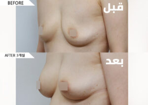 ar_breast03_bnf02_01