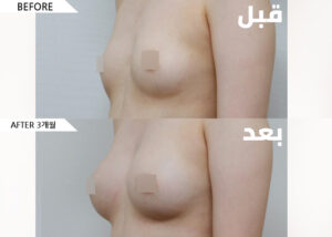 ar_breast03_bnf02_02