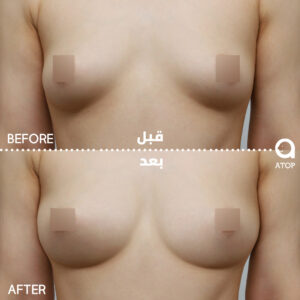 ar_breast03_bnf02_04